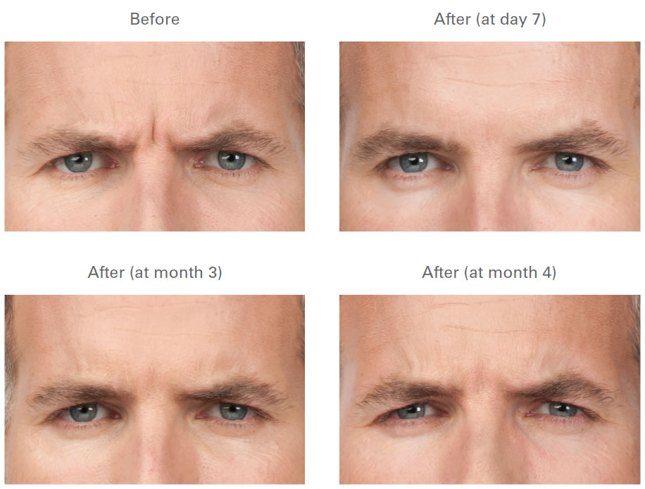 How Long To Notice Botox Results Tachibana