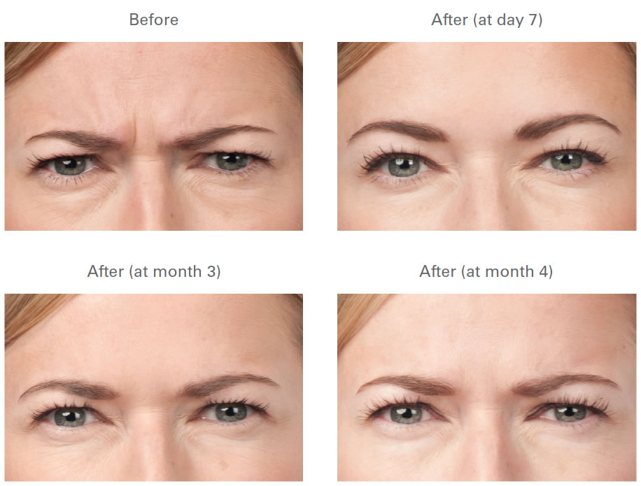 Botox® RVC Medical of Issaquah