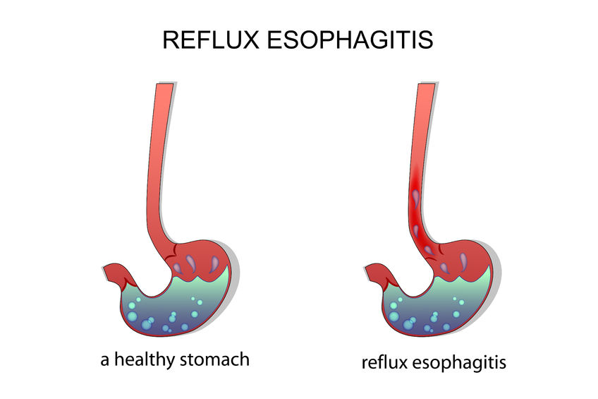 Nexium Dosage for Esophagitis, Costs, and Interactions Rx Assistance
