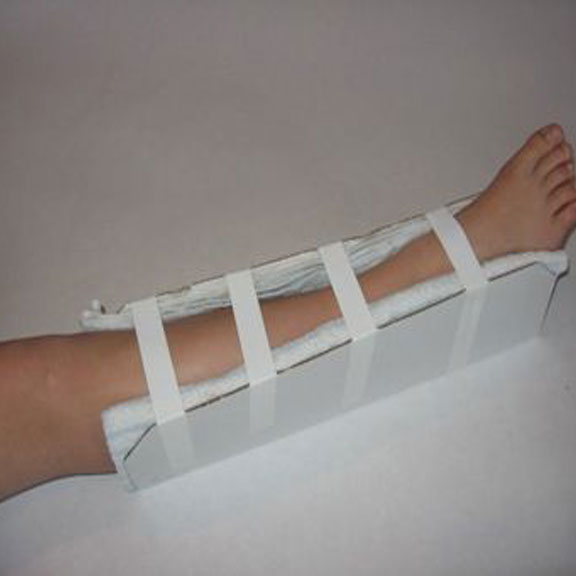 Purpose of splinting Smart Splint
