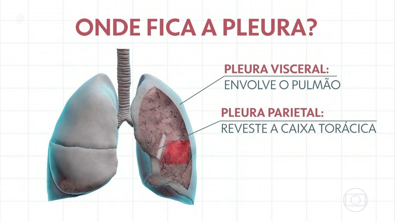 Bem Estar Derrame na pleura entenda o que é Globoplay