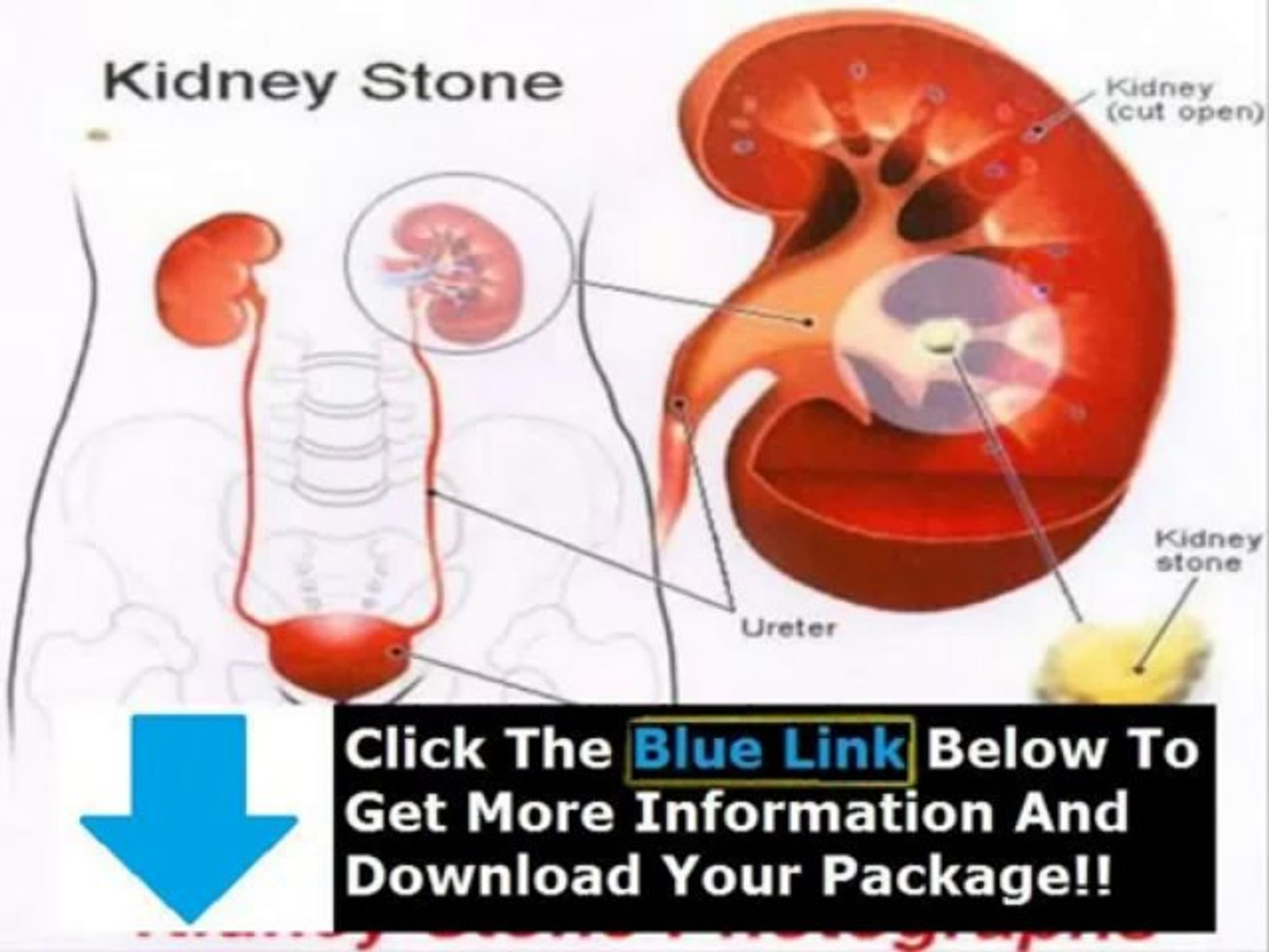Coke And Asparagus Recipe For Kidney Stones