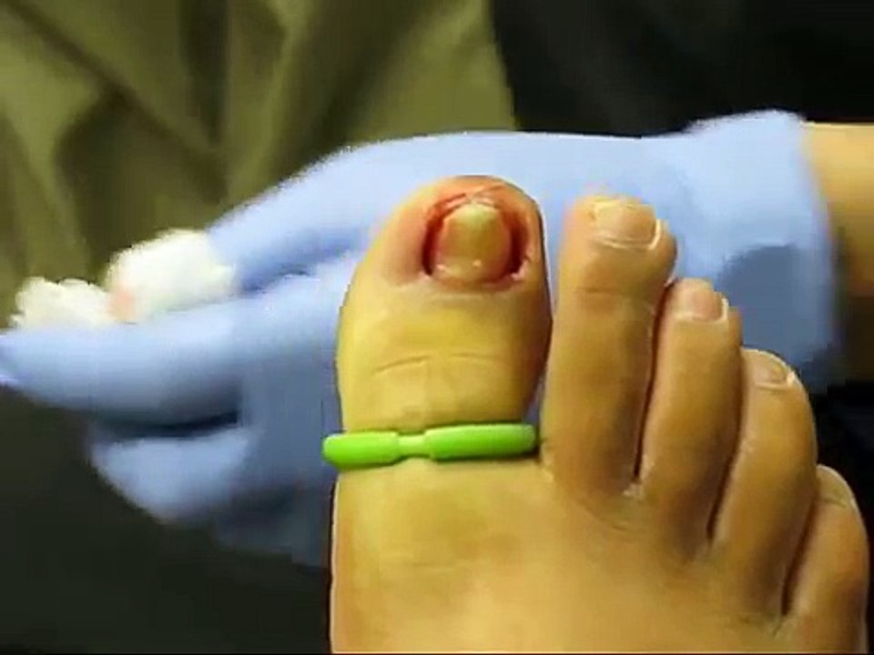 Ingrown Toenail Removal Surgery video Dailymotion