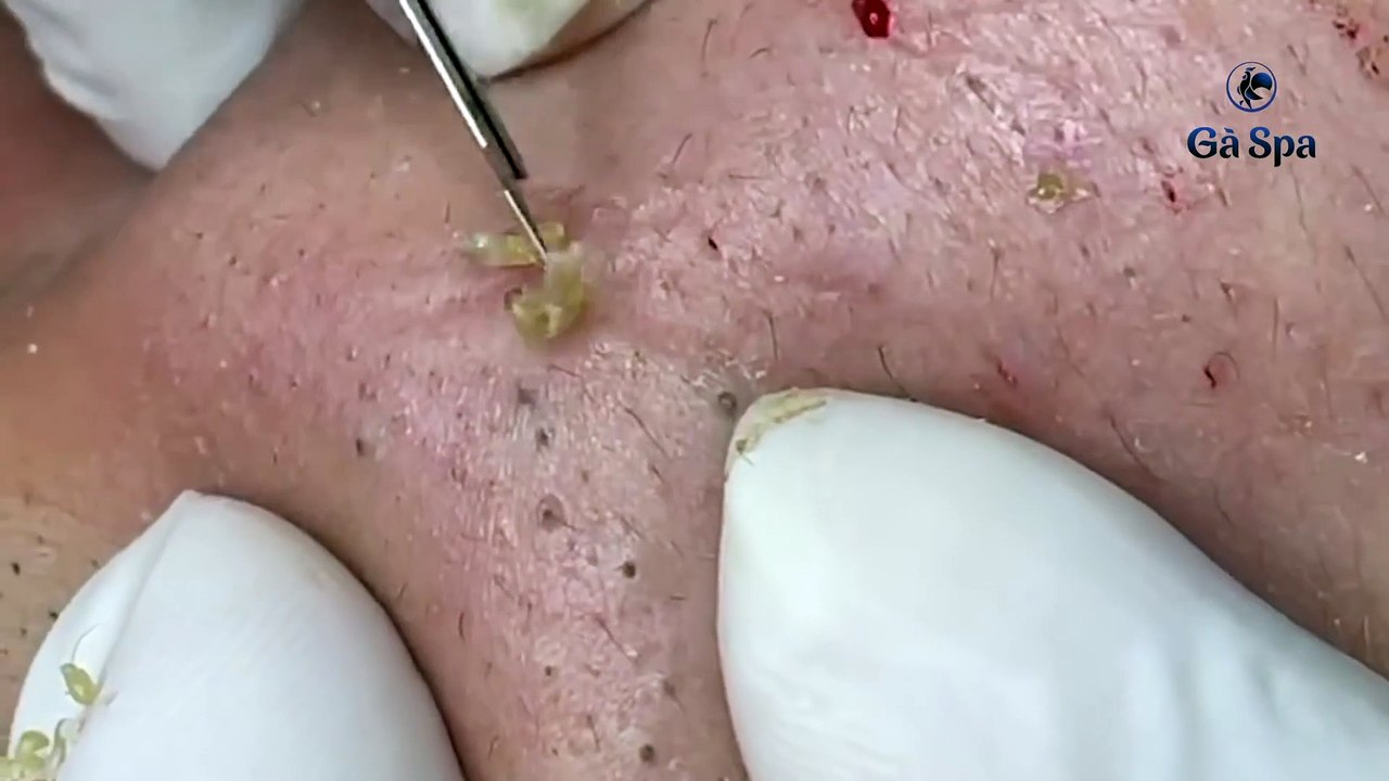 25 Grossest Zit Popping Videos Of All Time Pimple.