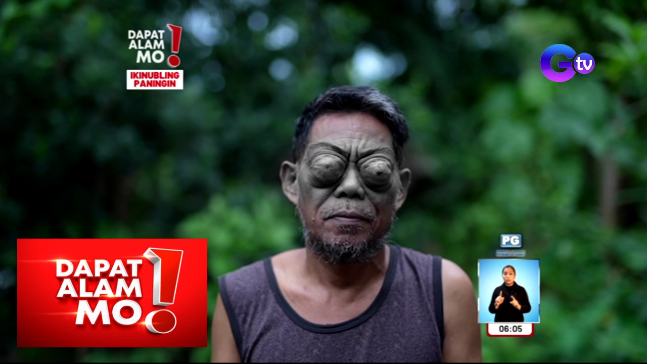 Dapat Alam Mo! Lalaking nakaluwa at namamaga ang mga mata, ano ang