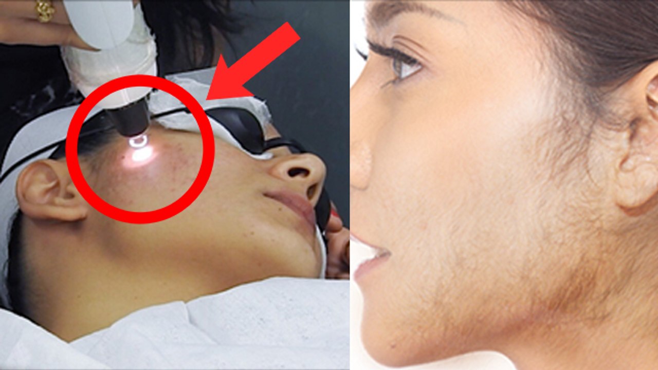 Laser Se Permanent Hair Remove Hota Hai Kya How Many Sittings For Laser Hair Removal Boldsky