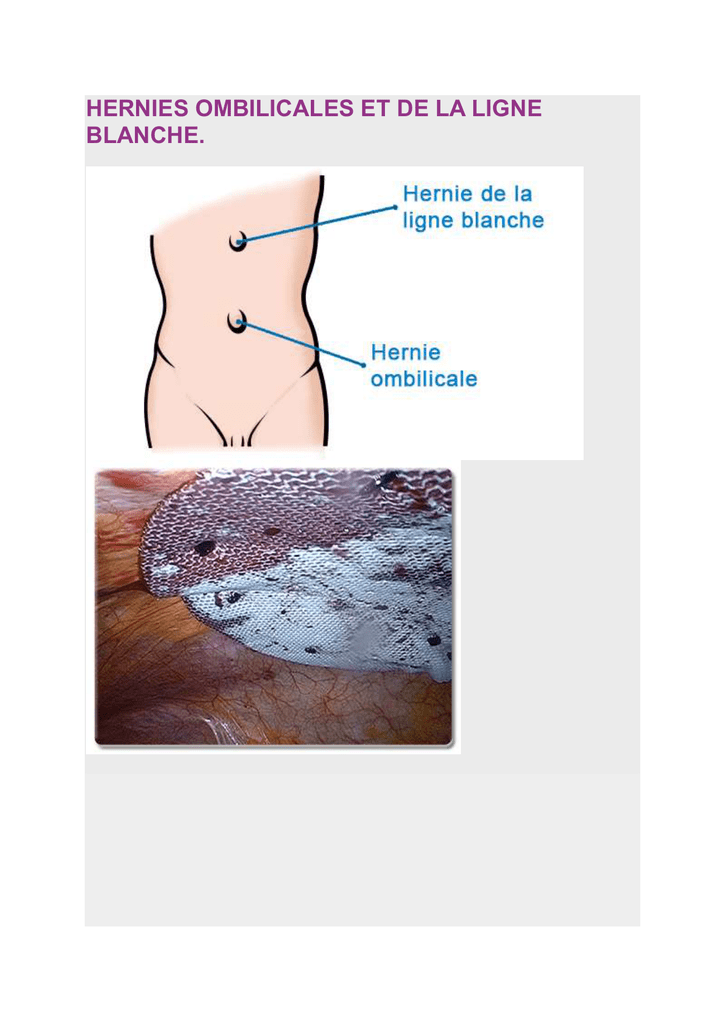 HERNIES OMBILICALES ET DE LA LIGNE BLANCHE