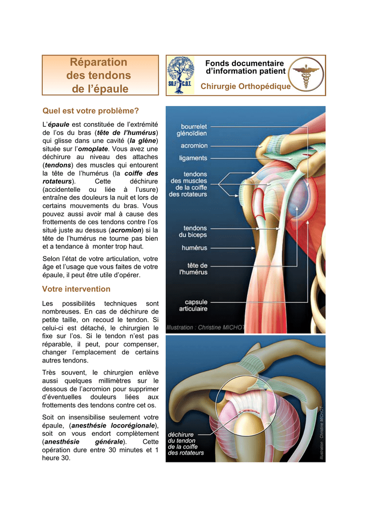 Réparation des tendons de l``épaule