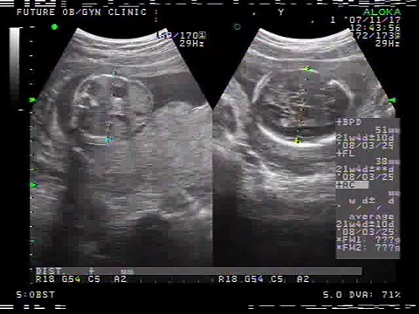 5 Month Pregnancy Baby Movement Video Dailymotion babypregnancy