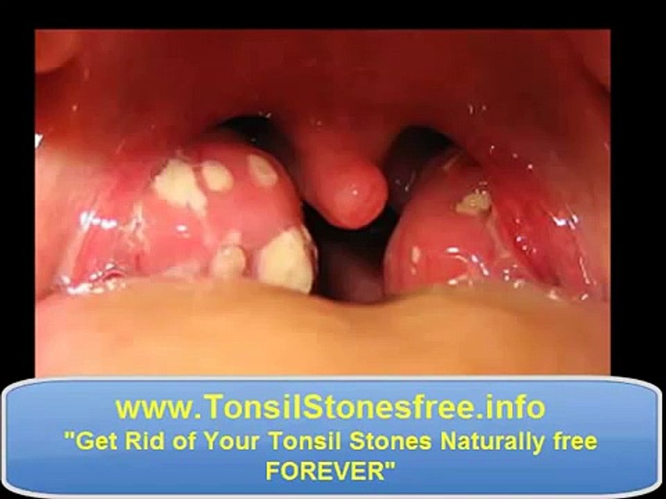 Waterpik tonsil stones ♣♣♣ How to remove Tonsil Stones ♣♣ video Dailymotion