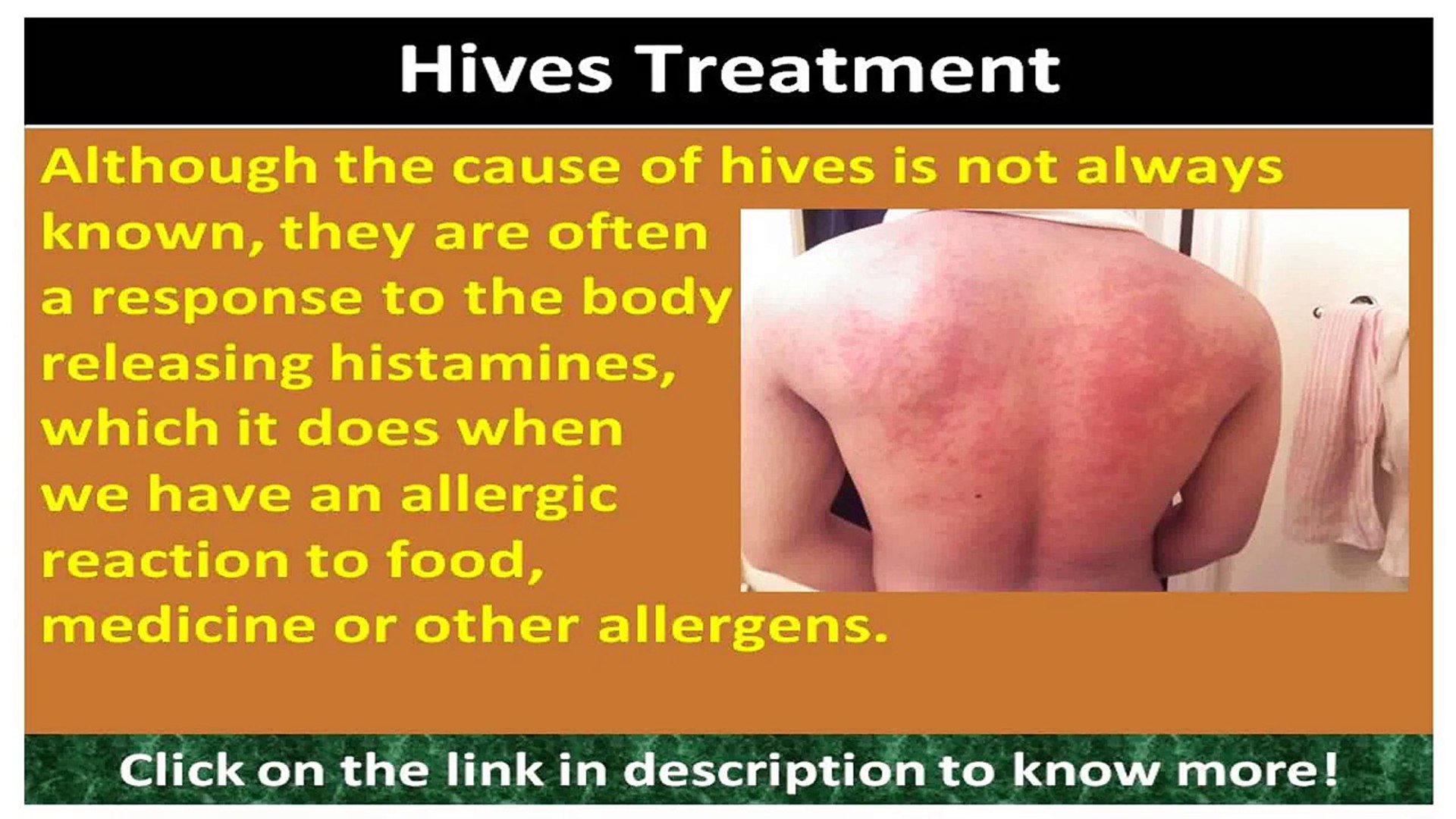 Booklet Medicine Hives Treatment