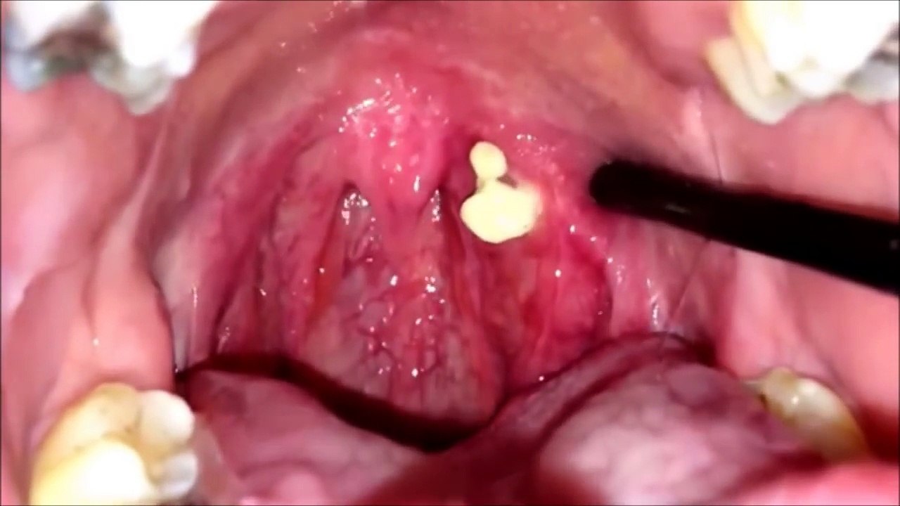 Tonsil stones removal BEST COMPILATION Видео Dailymotion
