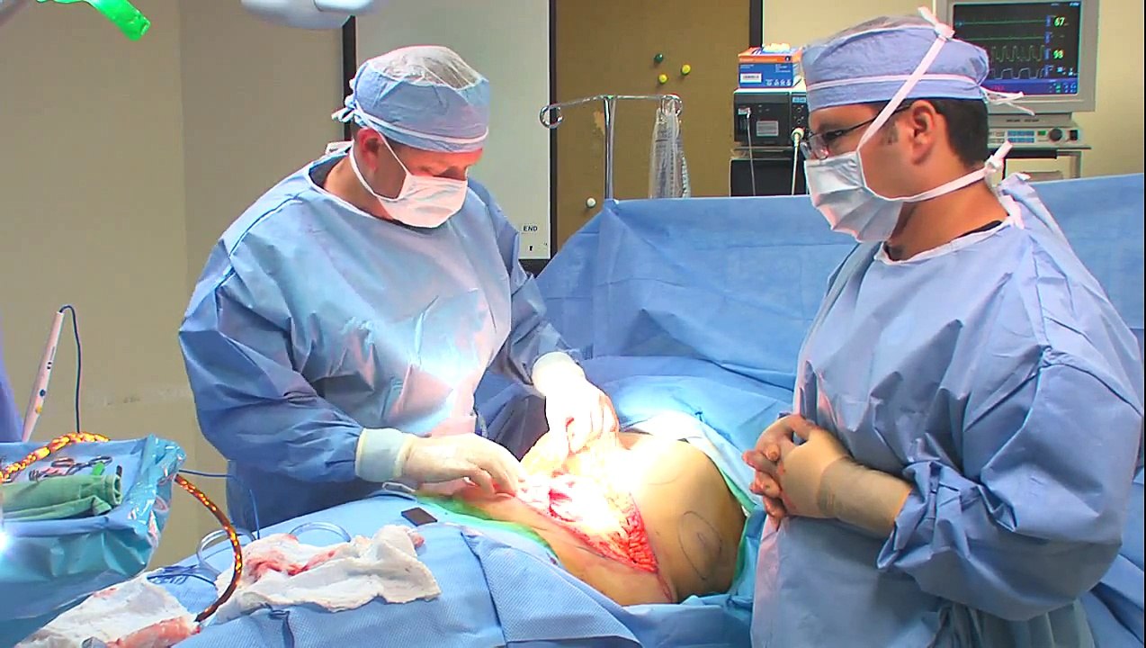 Miami Plastic Surgery Tummy Tuck (Abdominoplasty