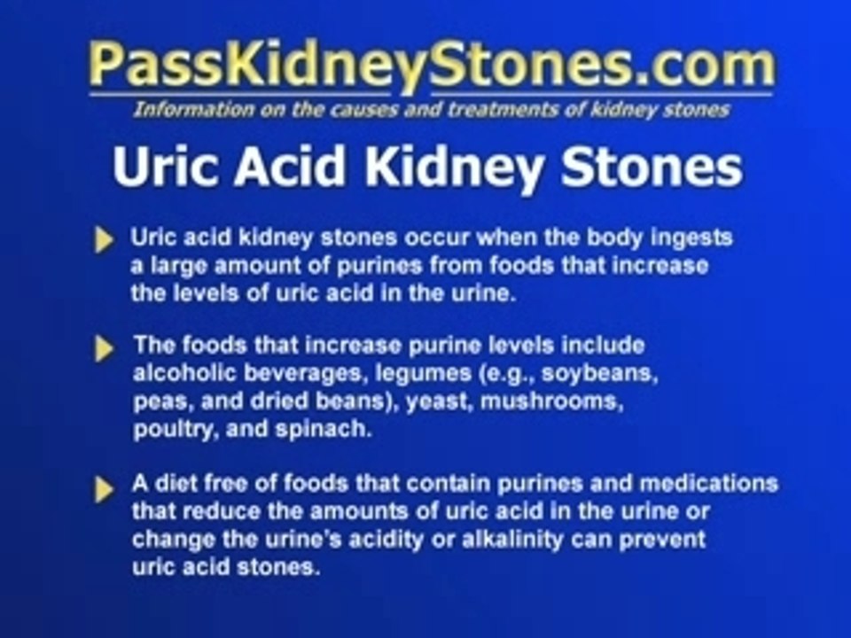 Uric Acid Kidney Stones video Dailymotion
