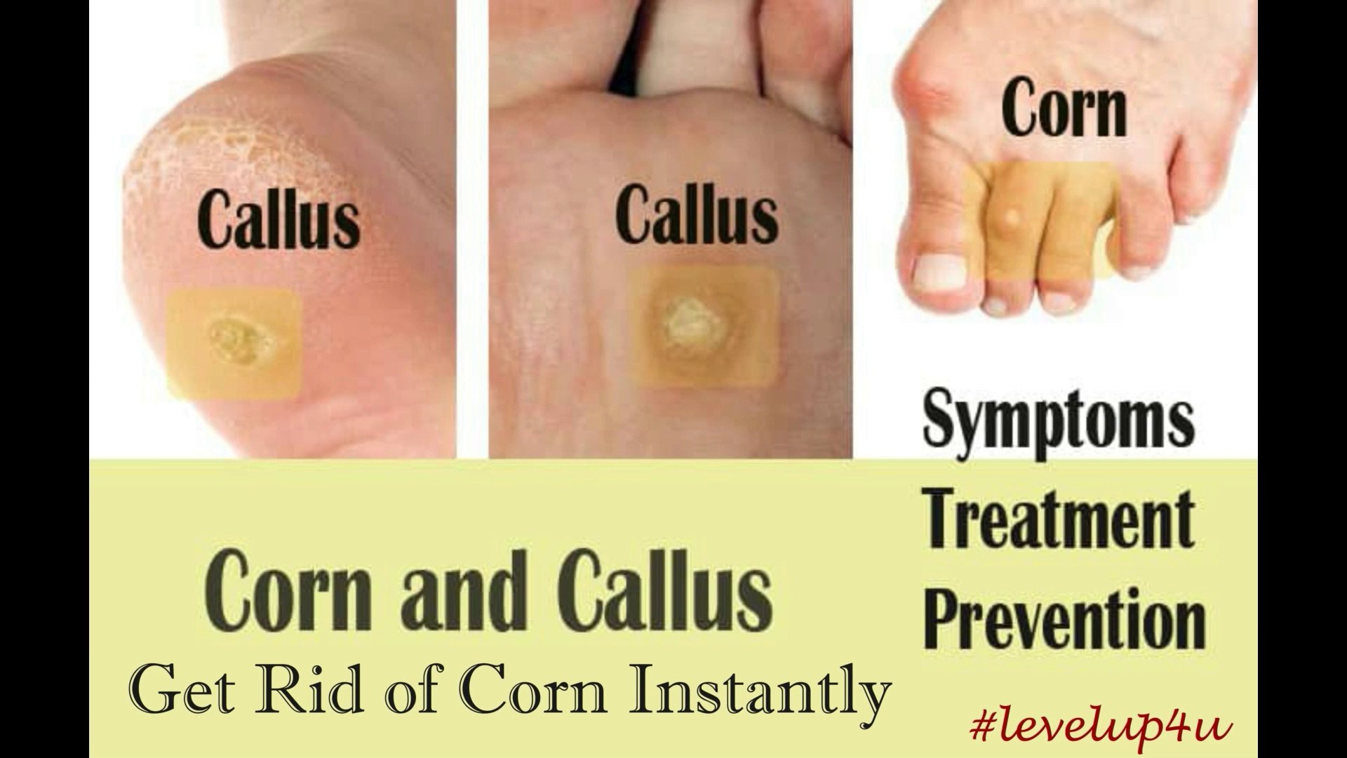 Painful Corn On Foot Treatment