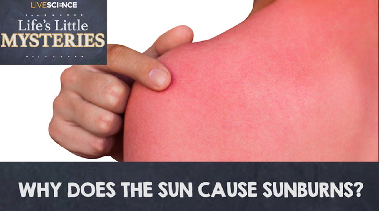 Why Does the Sun Cause Sunburns? video Dailymotion