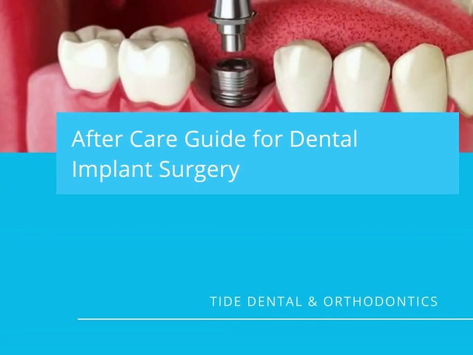 Recovering From Dental Implants Surgery 10 Life Hacks Tide Dental