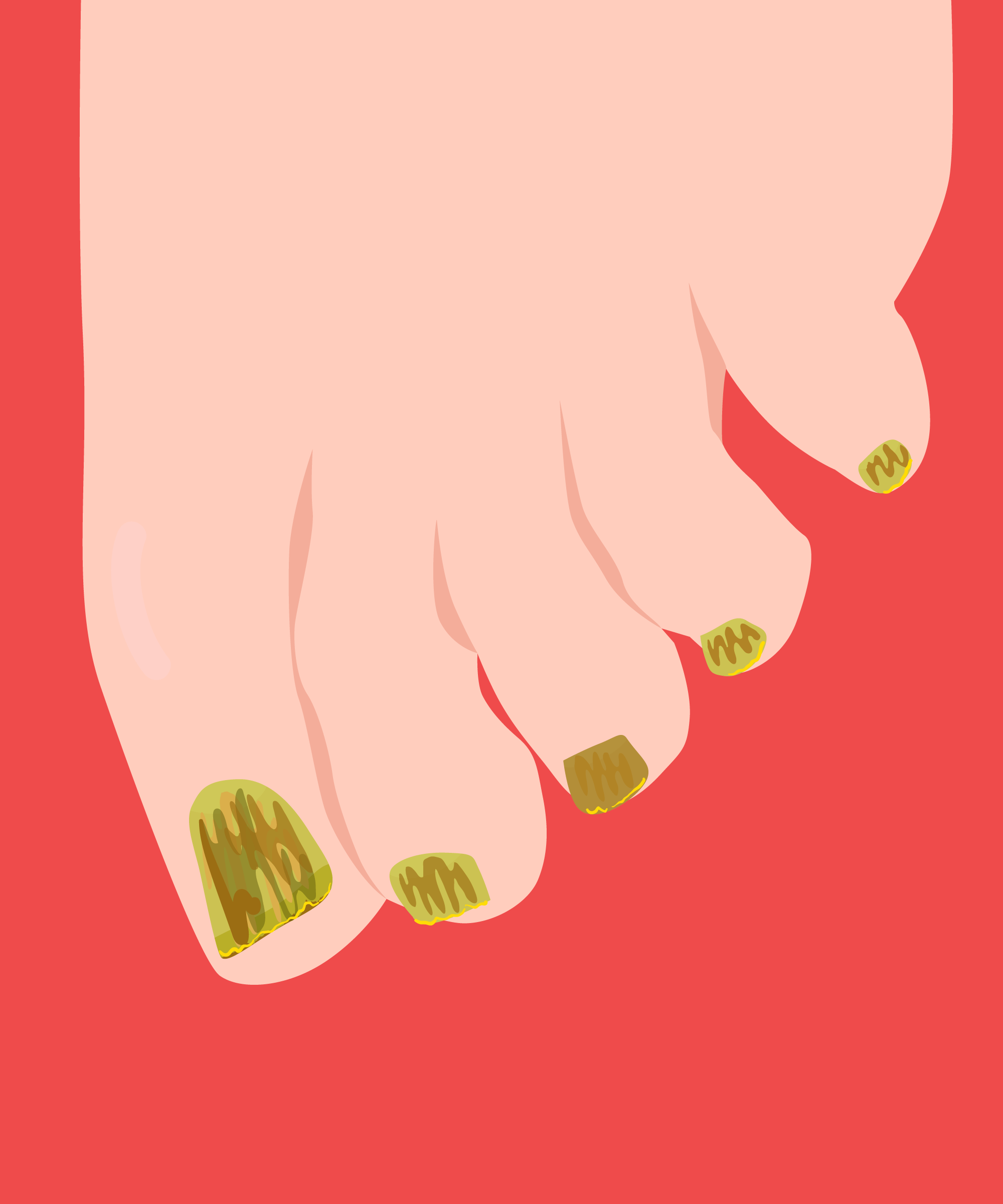 Eczema And Nails Falling Off Nail Ftempo