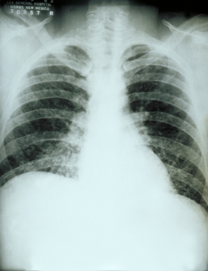 Fungal Diseases of the Respiratory System Boundless Microbiology