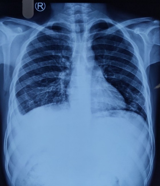 Lung Consolidation Vs Pleural Effusion