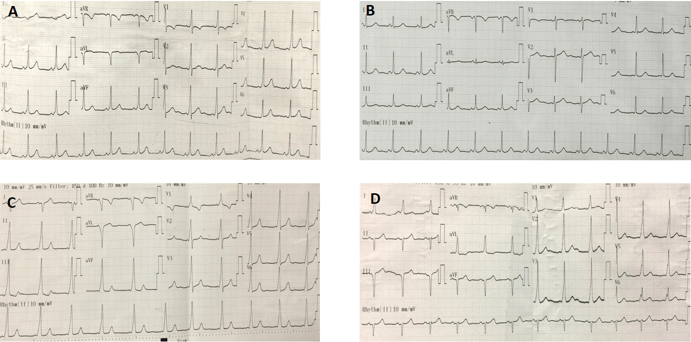 Development and evaluation of 12lead electrocardiogram in the left free wall of accessory