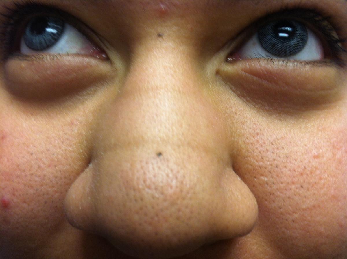 Allergic Rhinitis A Review of Treatment Options Consultant360