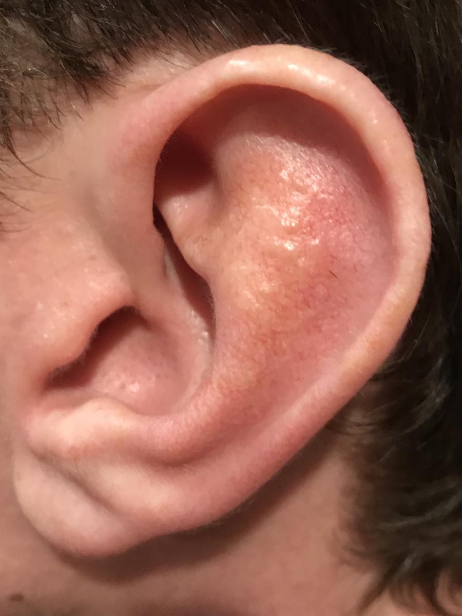 Herpes Simplex Virus Infection of the External Ear Consultant360