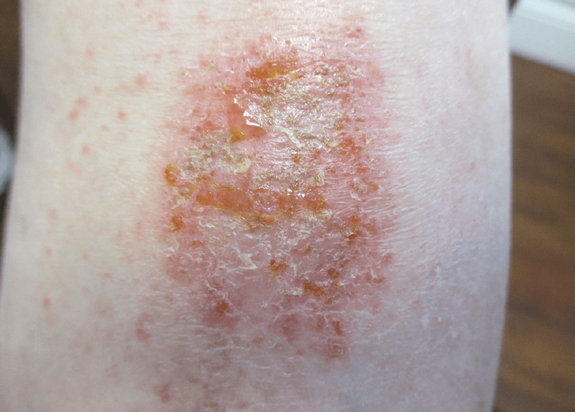 What Is Causing These Oozing, Crusting Plaques on a Man’s Shins
