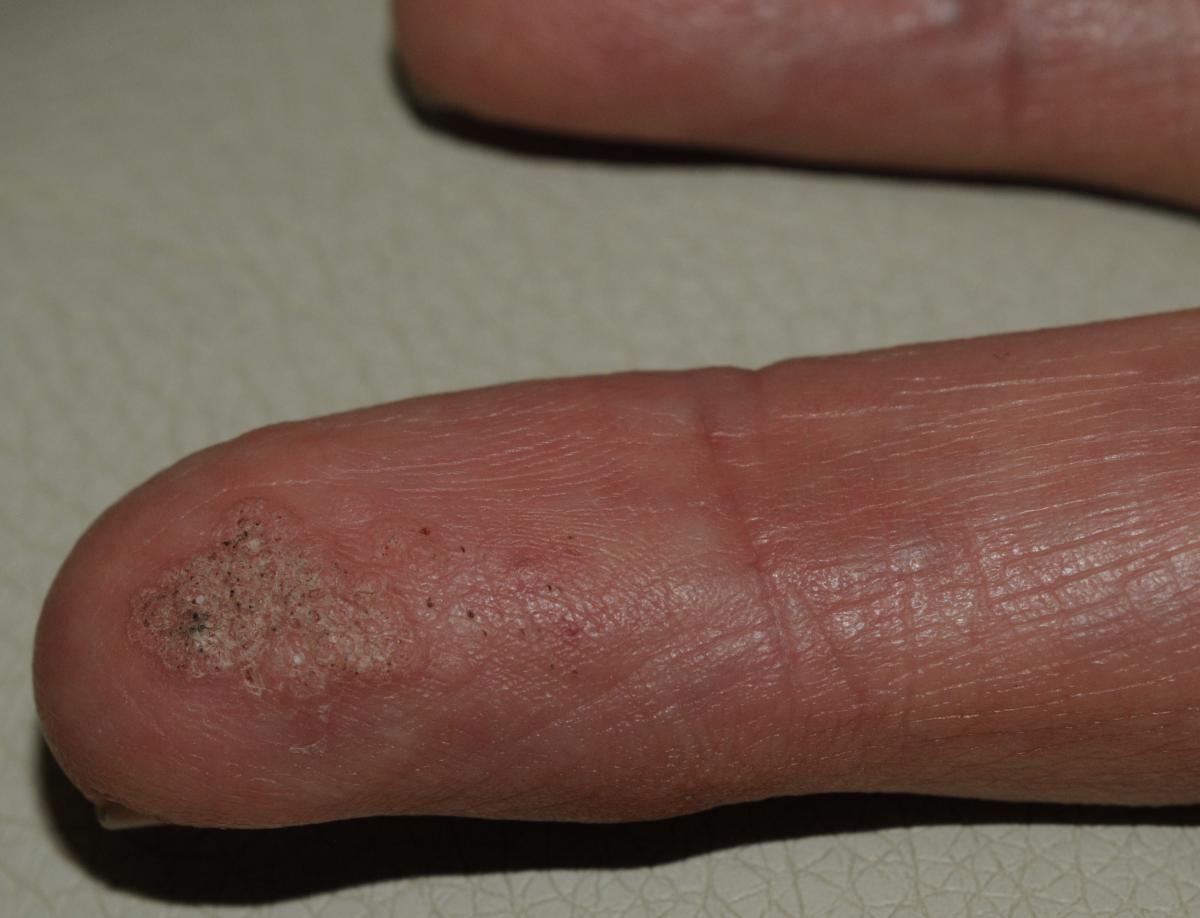 What Is the Cause of This Lesion? Consultant360