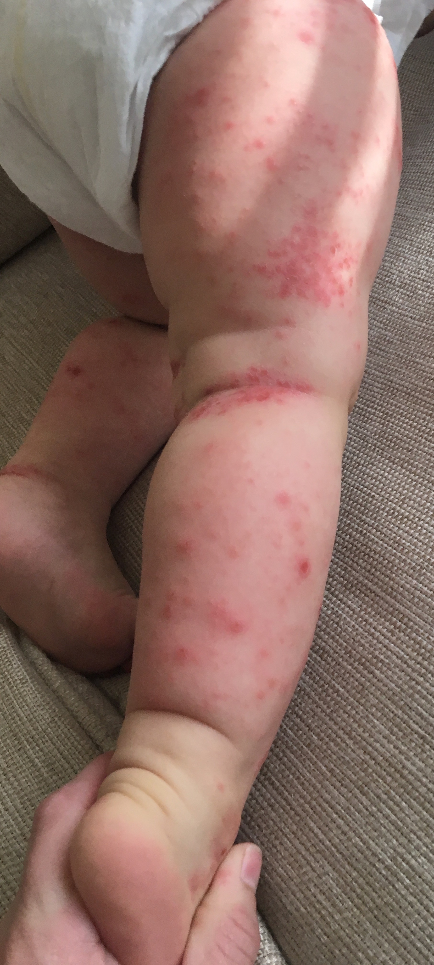 Atypical Hand-Foot-And-Mouth Disease | Consultant360