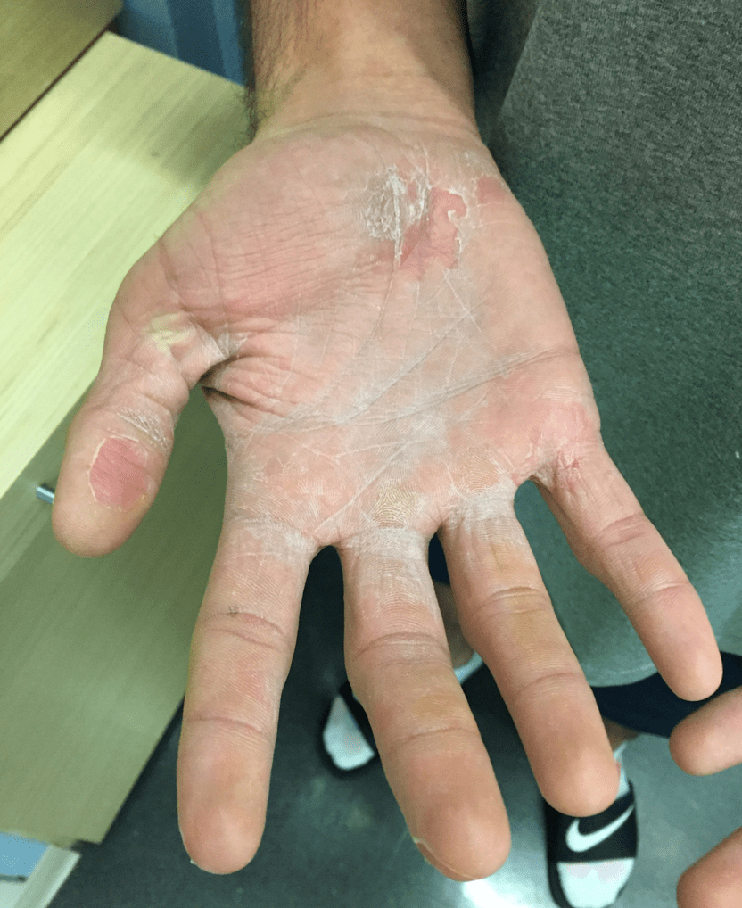 Staphylococcal Toxic Shock Syndrome From MethicillinSusceptible