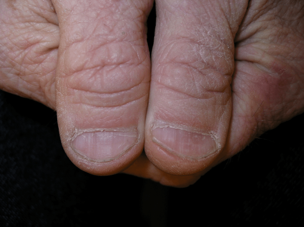 An Atlas of Nail Disorders, Part 3 Consultant360