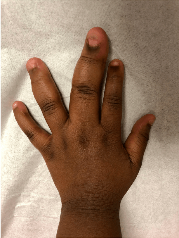 Isolated Macrodactyly Consultant360