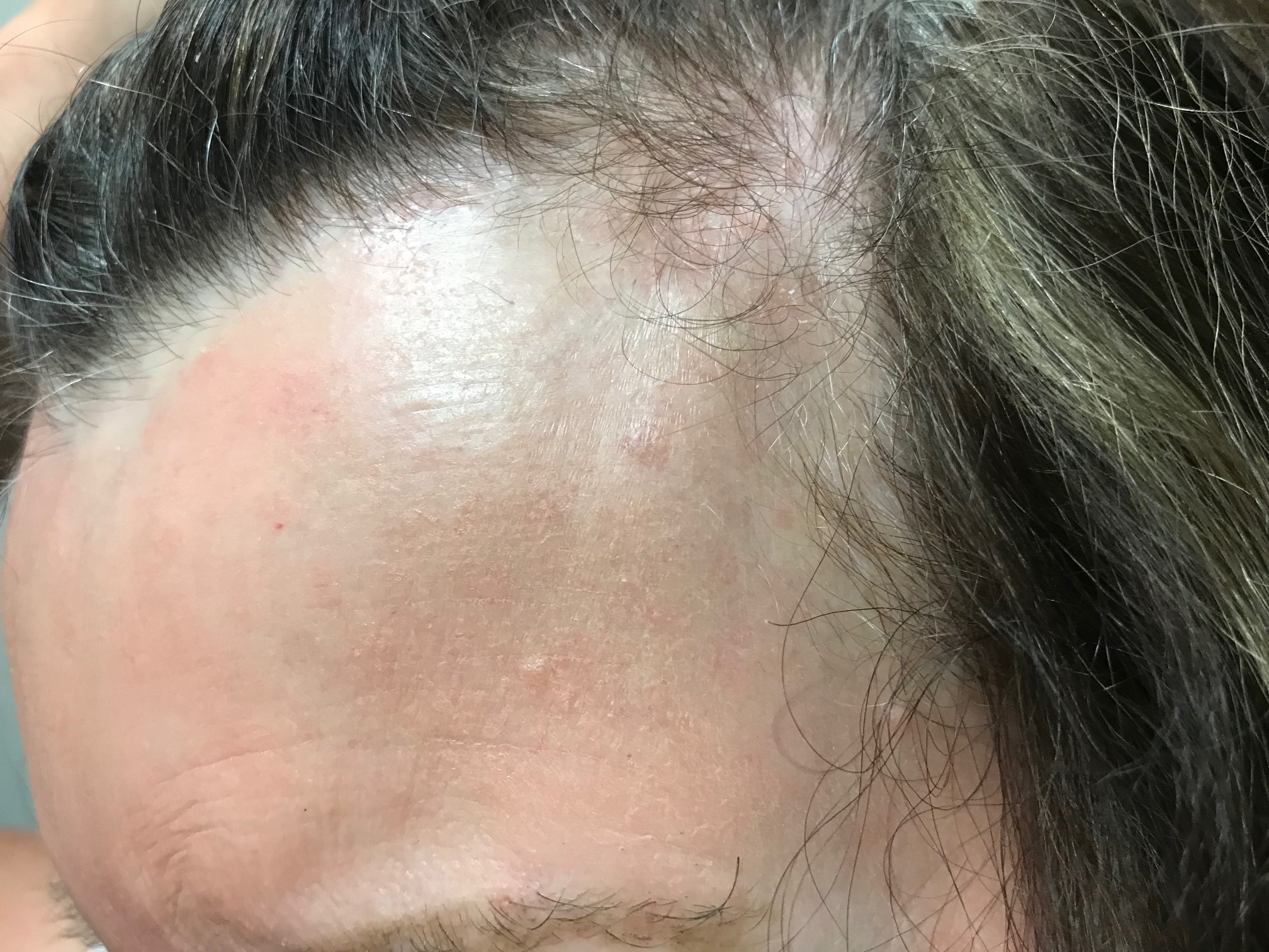 Tomato Allergy and the Link to Fragrance Allergy Consultant360