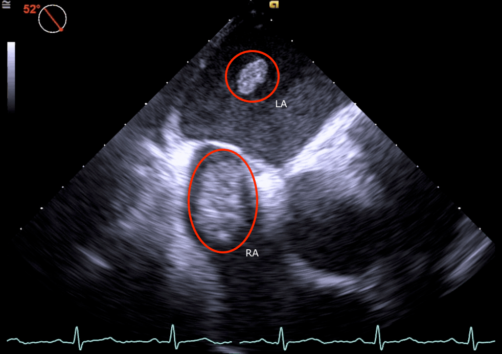 Caught in the Act Thrombus Straddling a Patent Foramen Ovale