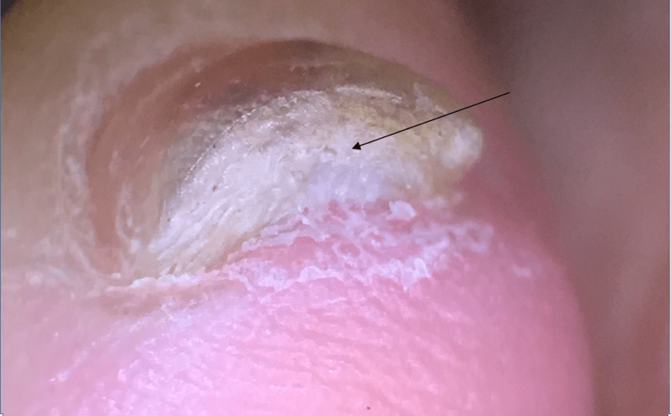 An Atlas of Nail Disorders, Part 7 Consultant360