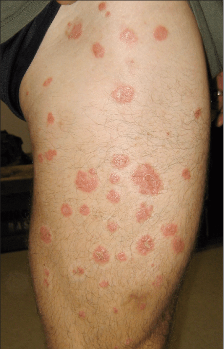 Psoriasis: Update On Therapeutic Choices | Consultant360