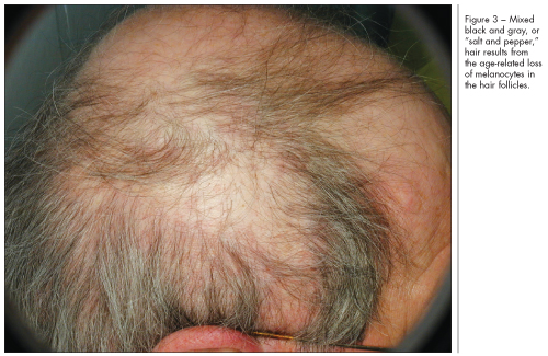 Skin Disorders In Older Adults: Age-Related Pigmentary Changes | Consultant360
