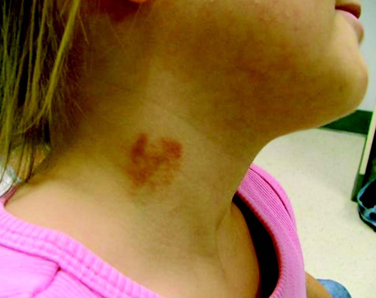 Child Abuseor Mimic? 6YearOld Girl With Marks on Neck Consultant360