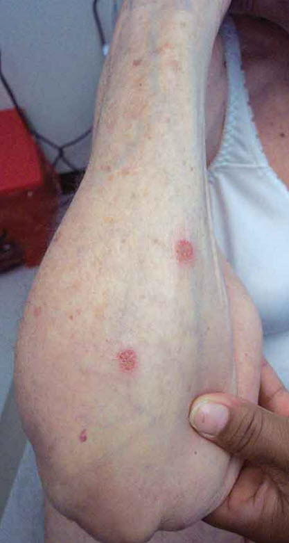 Nummular Eczema | Consultant360