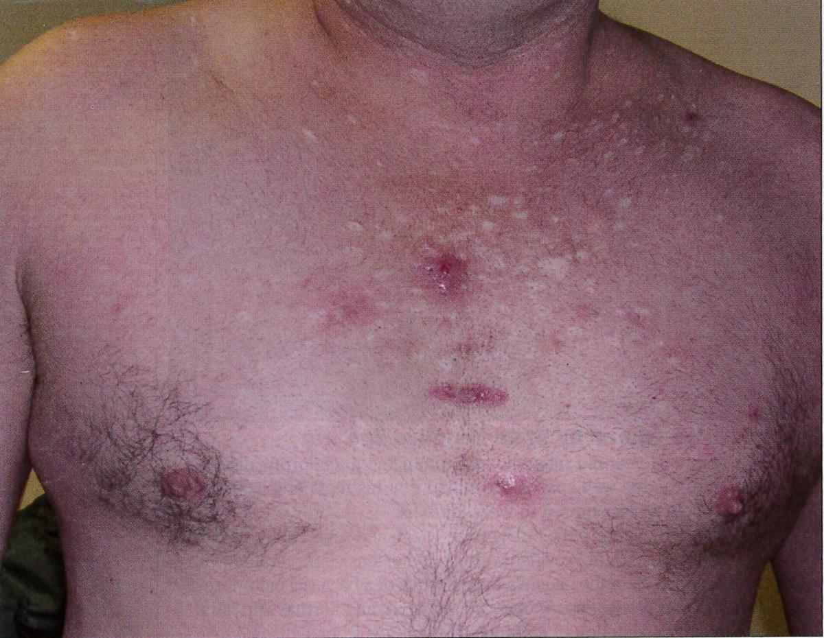 What is Responsible for This Man’s Recurring Painful Cysts? Consultant360