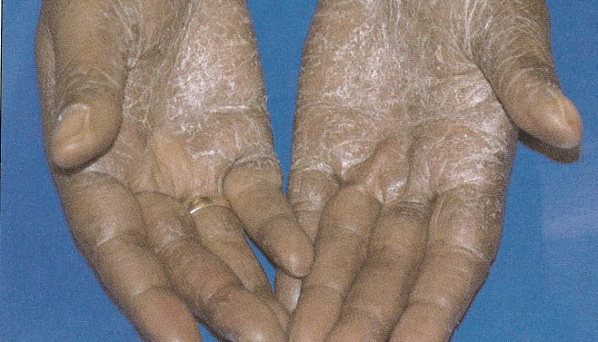 Skin Disorders In Elderly Persons: Part 5, Fungal Infections (Tinea Manuum) | Consultant360