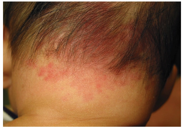 Salmon Patches Consultant360