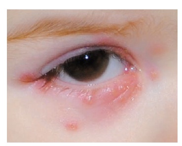 Eczema Herpeticum With Atopic Dermatitis | Consultant360