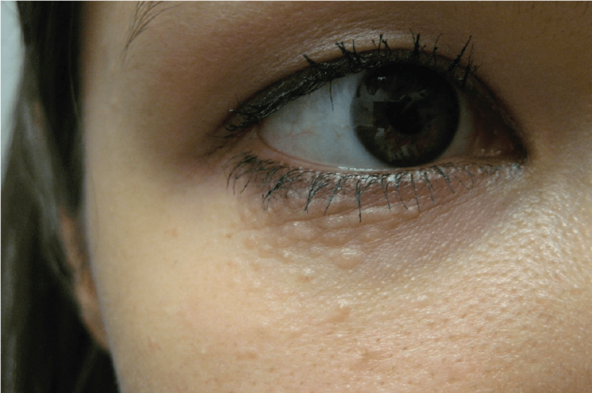 Can You Identify The Papules Below This Woman's Eyes? | Consultant360