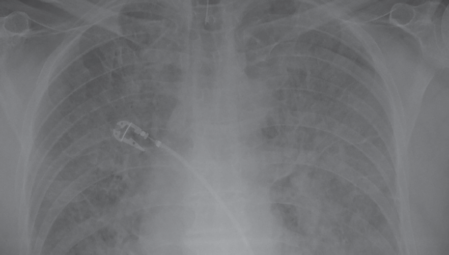 Atypical Presentation of Acute Myocardial Infarction Consultant360