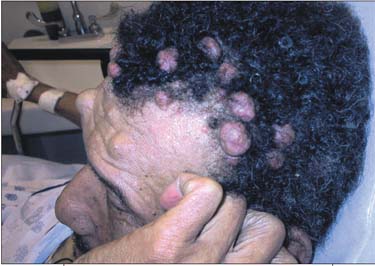 An Old Man With A Stroke And Multiple Bumps On His Head | Consultant360