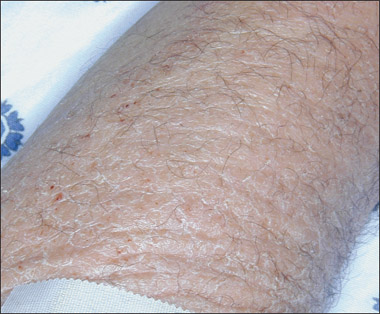 Skin Disorders In Older Adults: Eczematous And Xerotic Inflammatory Conditions, Part 1 | Consultant360