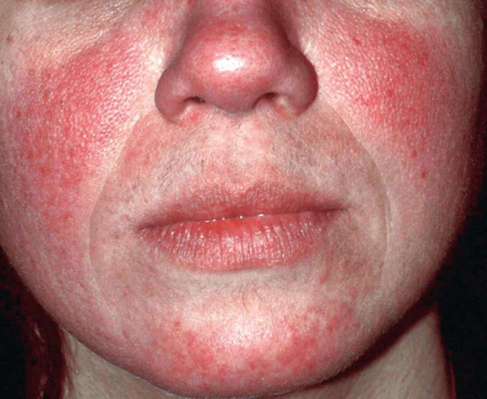 Rosacea Diagnosis and Management of a Complex and Significant Disorder