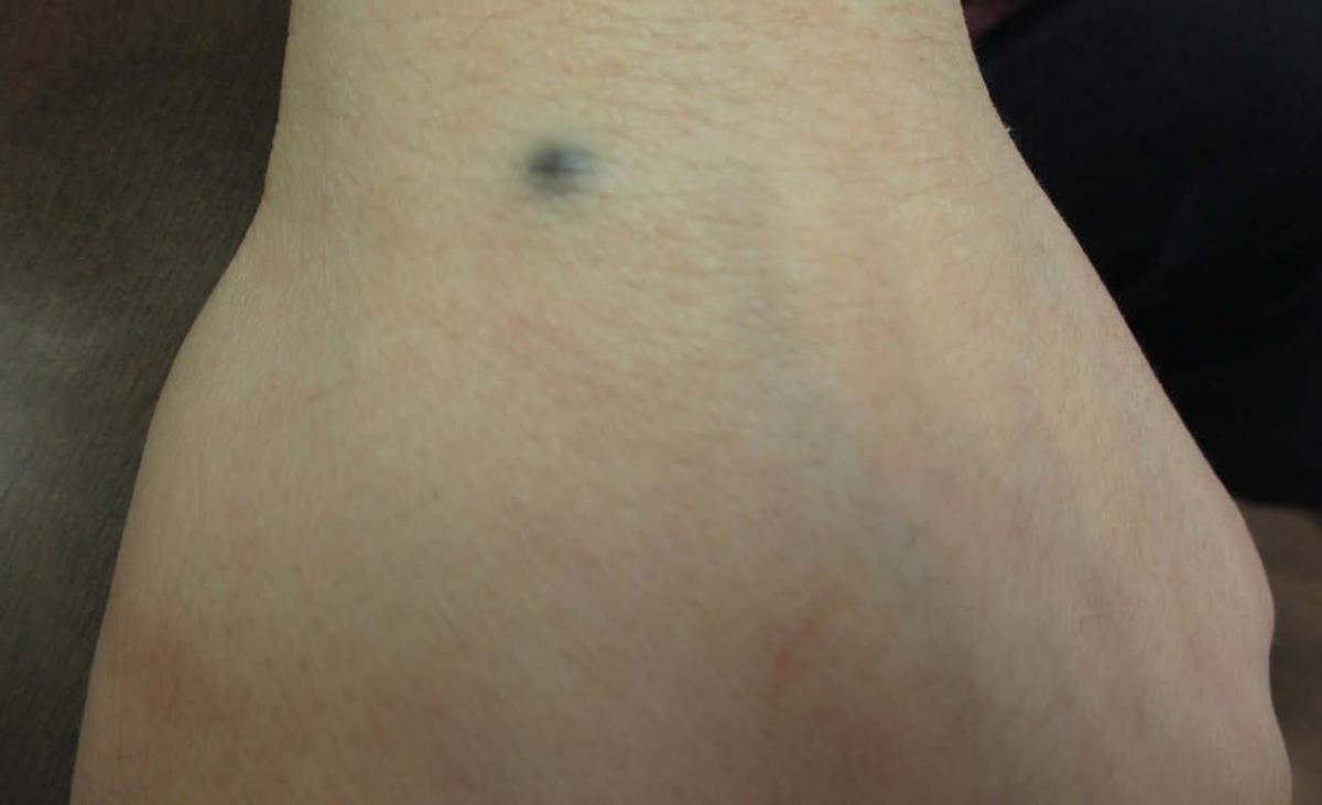 An Adolescent With a Smooth, BlueBlack Nodule on the Dorsal Wrist
